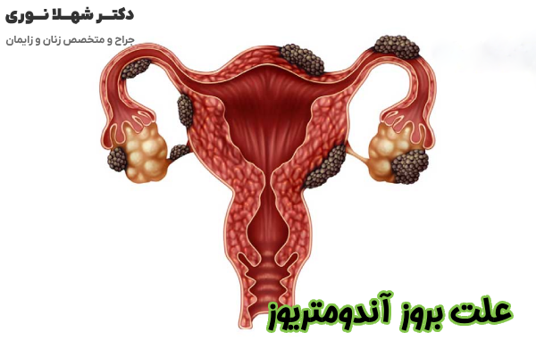 دلایل بروز آندومتریوز