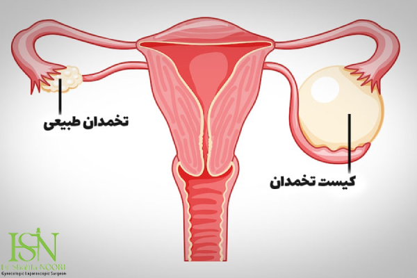 دلایل بروز کیست تخمدان