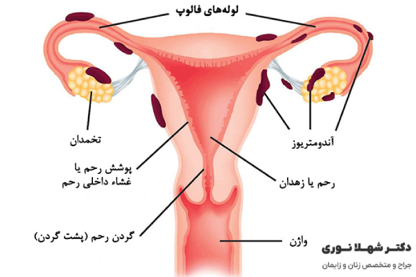 عوارض بیماری آندومتریوز