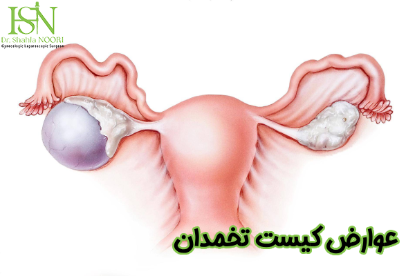 عوارض کیست تخمدان