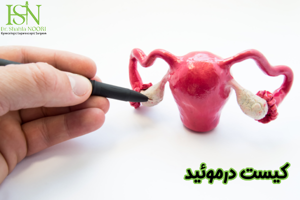کیست درموئید