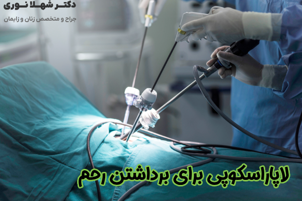 لاپاراسکوپی برای برداشتن رحم