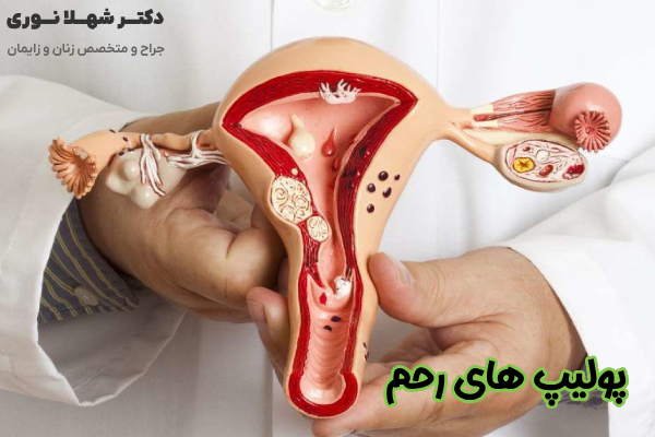 پولیپ های رحم