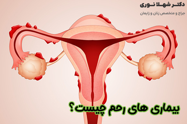 بیماری های رحم چیست؟