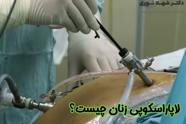 لاپاراسکوپی زنان چیست