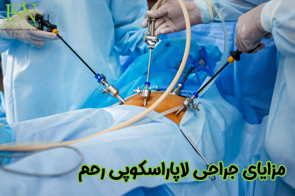مزایای جراحی لاپاراسکوپی رحم