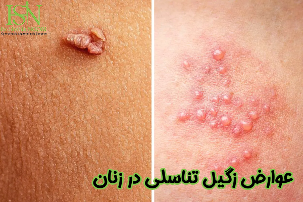 عوارض زگیل تناسلی