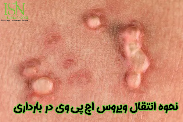 نحوه انتقال ویروس HPV در بارداری