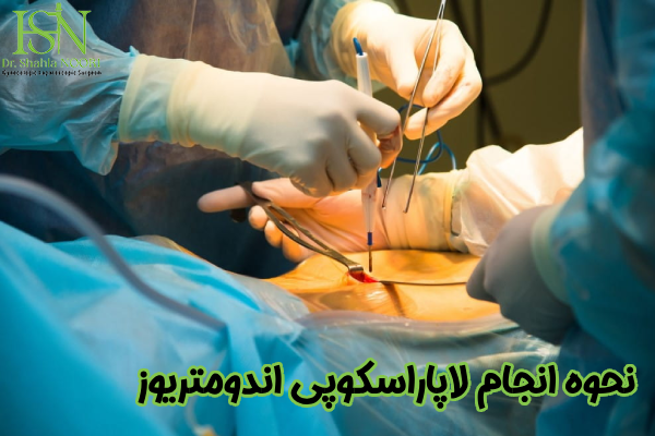 نحوه انجام لاپاراسکوپی اندومتریوز
