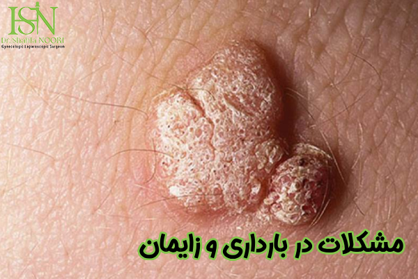 مشکلات در بارداری و زایمان