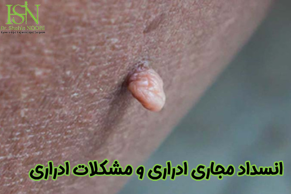 انسداد مجاری ادراری و مشکلات ادراری