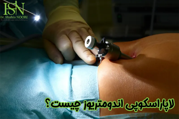 لاپاراسکوپی اندومتریوز چیست