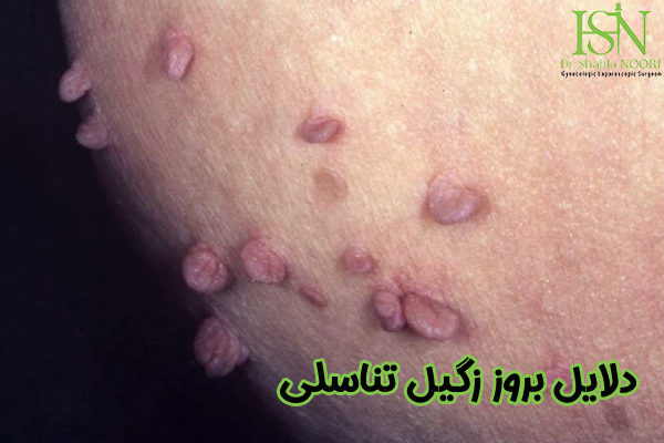 دلایل بروز زگیل تناسلی