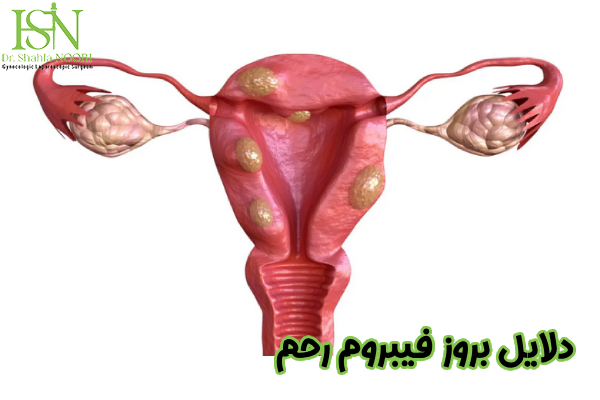 دلایل بروز فیبروم رحم