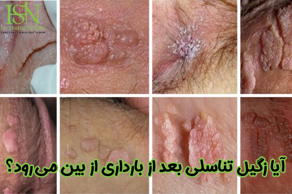آیا زگیل تناسلی بعد از بارداری از بین می رود؟