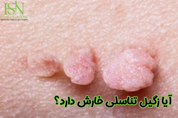 آیا زگیل تناسلی خارش دارد؟