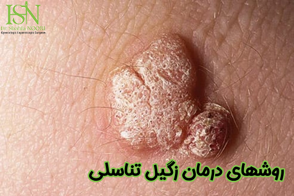 روشهای درمان زگیل تناسلی