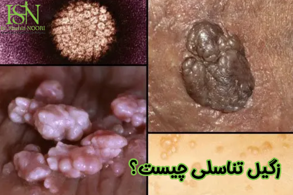 زگیل تناسلی چیست