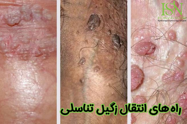 راه های انتقال زگیل تناسلی چیست
