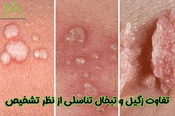 تفاوت زگیل و تبخال از نظر تشخیص