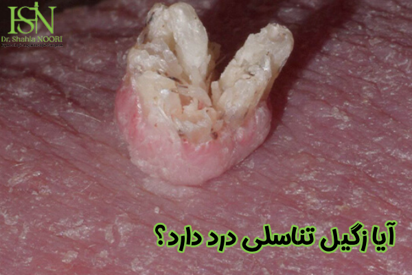 درد زگیل تناسلی