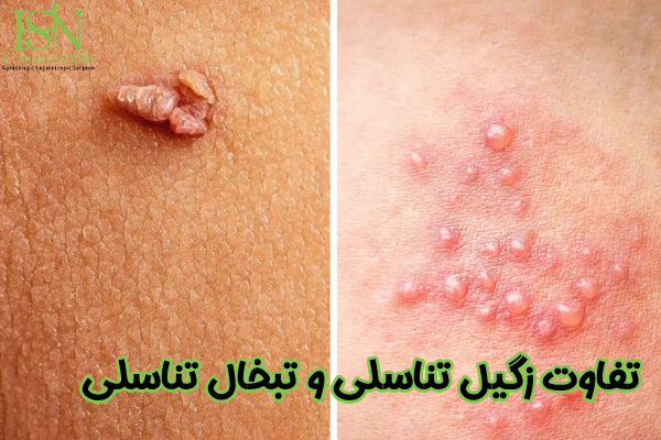 تفاوت زگیل تناسلی و تبخال تناسلی