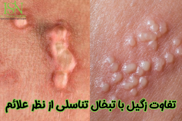 تفاوت زگیل با تبخال از نظر علائم