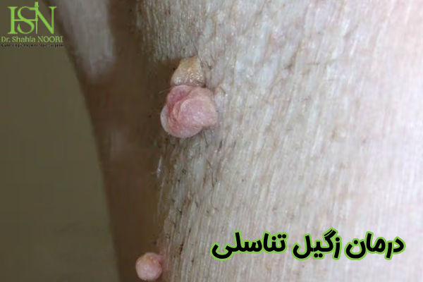 درمان زگیل تناسلی چیست