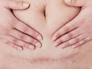 اندومتریوز در محل سزارین