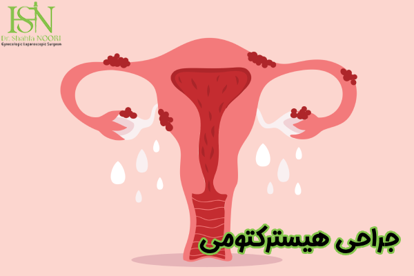 جراحی هیسترکتومی