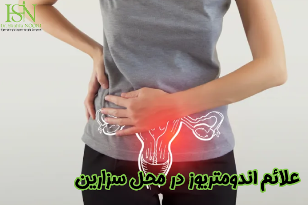 علائم اندومتریوز در سزارین