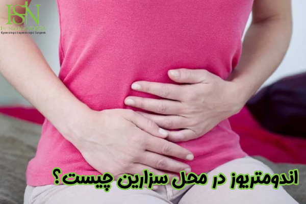 اندومتریوز در محل سزارین چیست