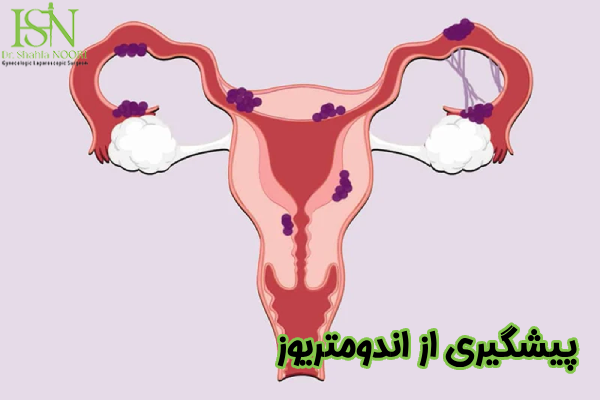 پیشگیری از اندومتریوز چیست