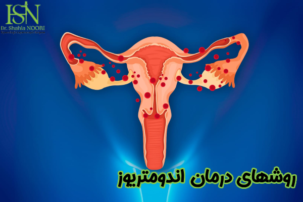 درمان اندومتریوز چیست