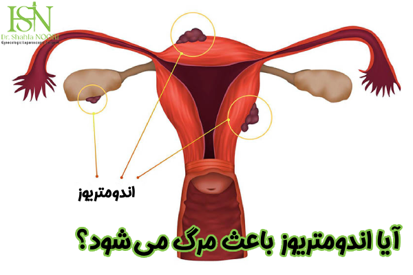 آیا اندومتریوز باعث مرگ می شود؟