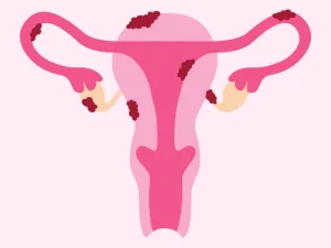آیا اندومتریوز خطرناک است