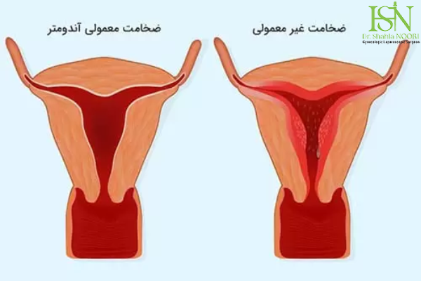 ضخامت طبیعی اندومتر