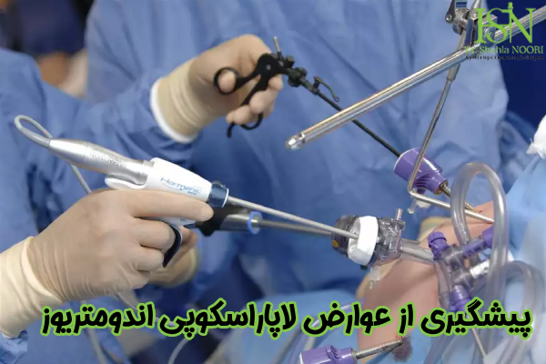 پیشگیری از عوارض لاپاراسکوپی اندومتریوز