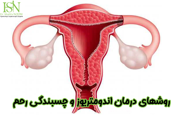 درمان اندومتریوز و چسبندگی