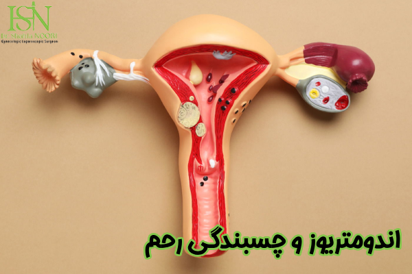 اندومتریوز و چسبندگی رحم چیست