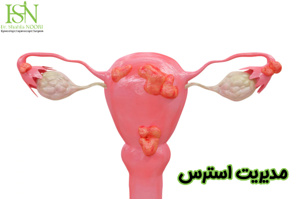 مدیریت استرس بعد از لاپاراسکوپی اندومتریوز