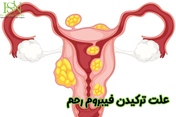 علت ترکیدن فیبروم رحم