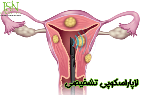 لاپاراسکوپی تشخیصی