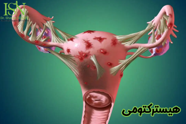 هیسترکتومی
