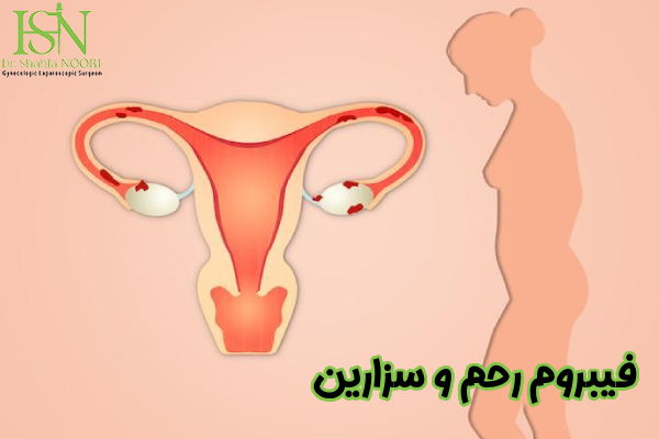 فیبروم رحم و سزارین