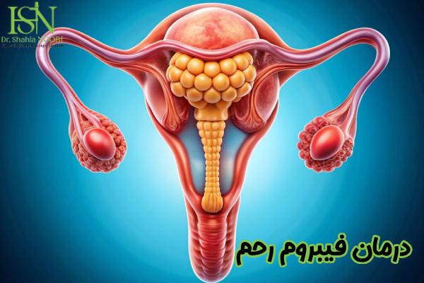 درمان فیبروم رحم چیست
